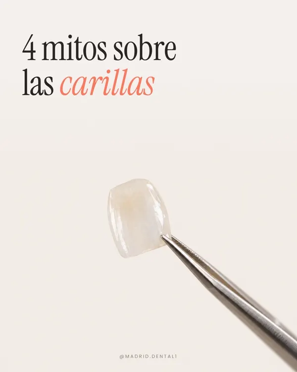 Carrusel: 4 mitos sobre las carillas
